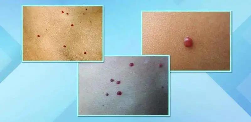 身上莫名其妙的出現血痣，怎么辦？