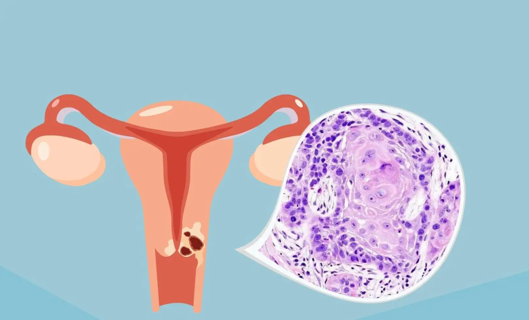 不疼不癢，竟然查出“宮頸癌”！這“3個(gè)信號”要警惕！